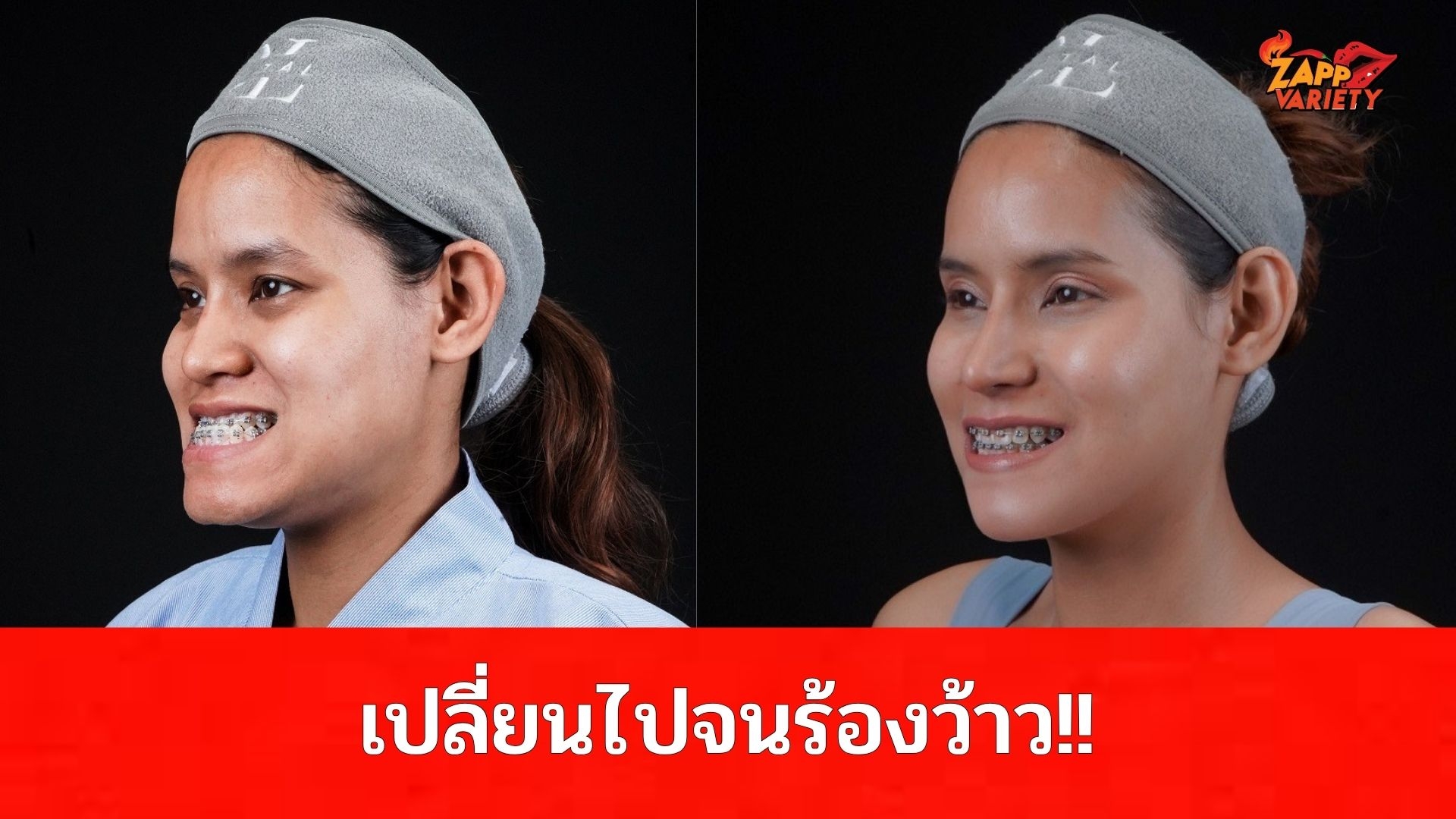 เปลี่ยนไปจนต้องร้องว๊าว!! คุณมด” จากสาวถูกคนอื่นบูลลี่ “หน้าเหมือนแม่มด” สู่ผู้ชนะของรายการSurgery Wars EP.8 